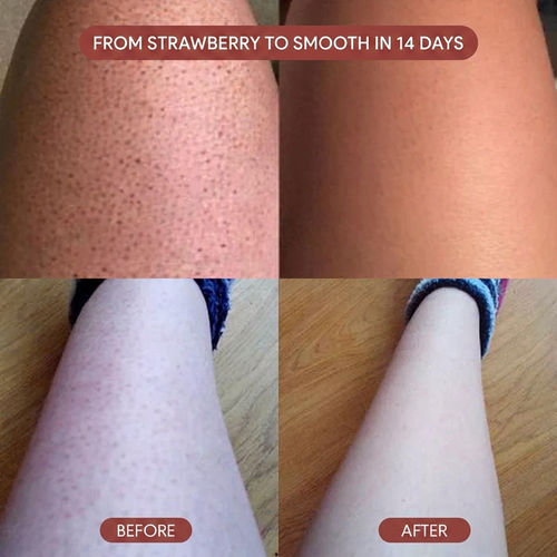 Triple Acid Keratosis Pilaris Complex